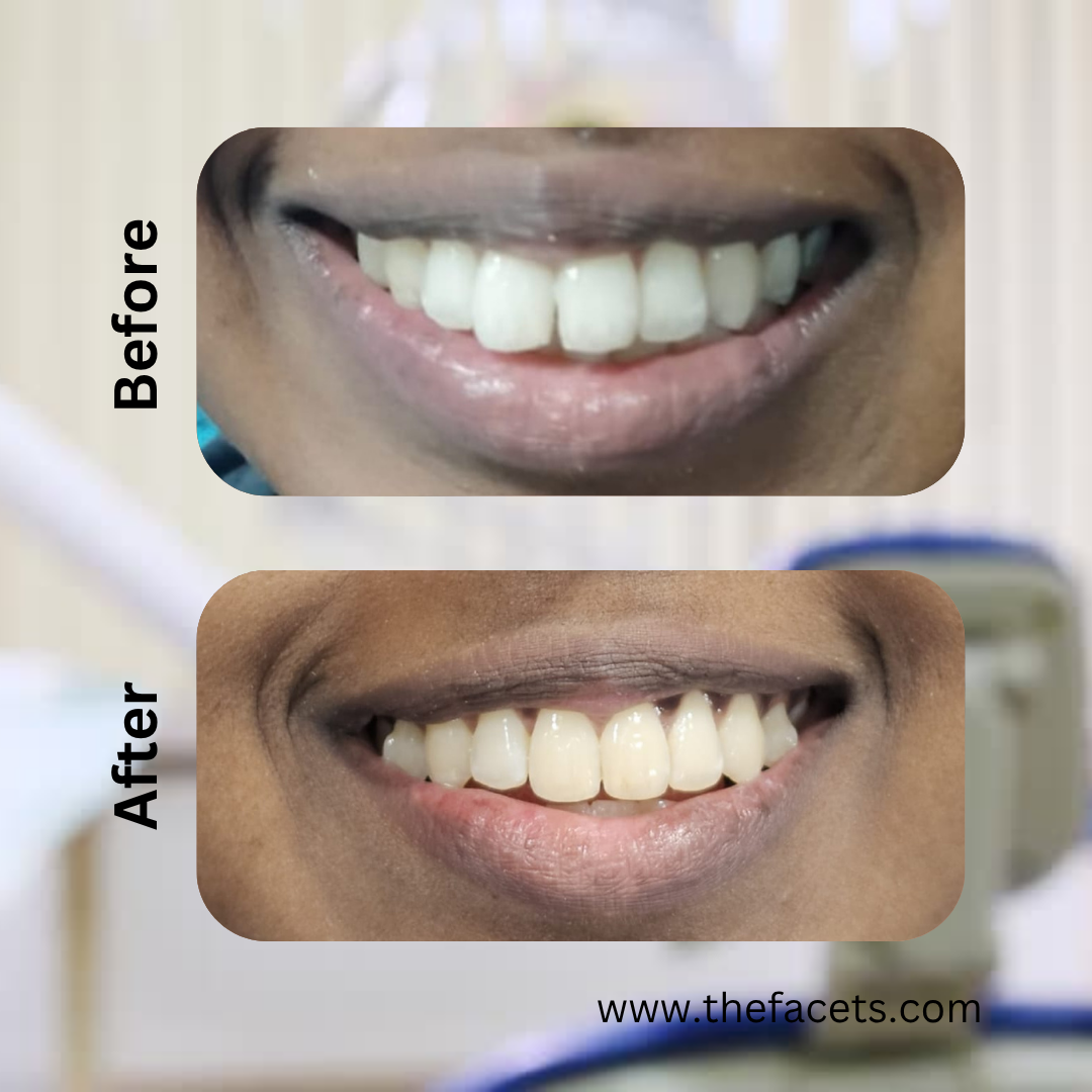 Before and after braces treatment result 3